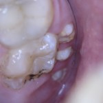 сверхкомплектные зубы